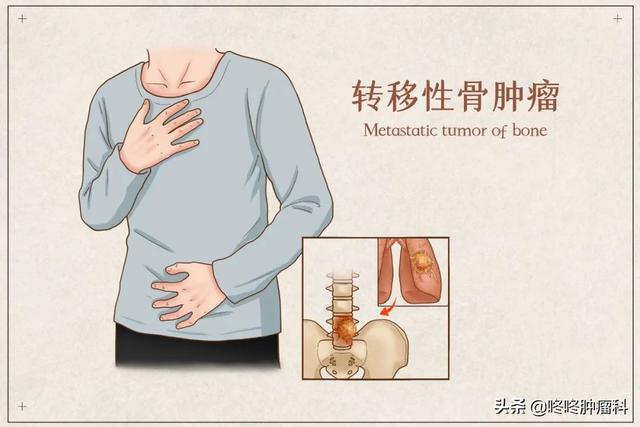 腰椎間盤突出、肩周炎:這些常見的不適癥狀,很有可能是癌癥的征兆