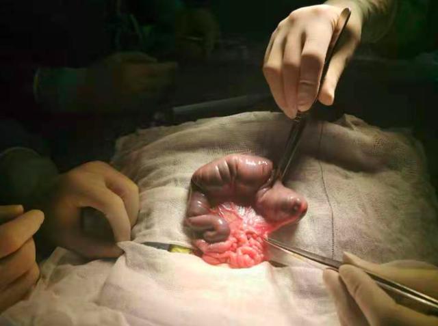 当分娩日撞上闭环日，新华医院成功抢救先天消化道闭锁新生儿