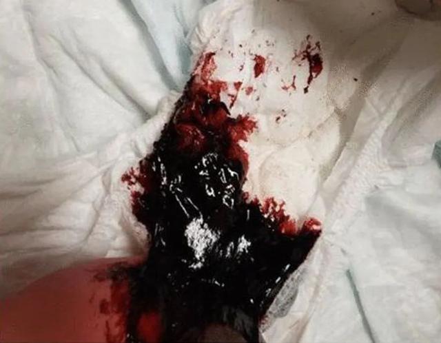 新生儿便血（新生儿吞咽综合征）