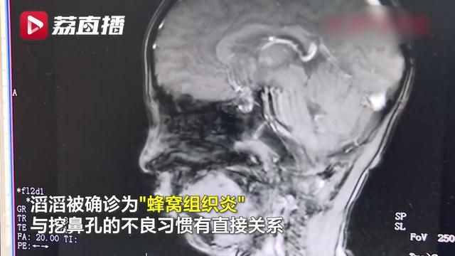 5岁男孩爱挖鼻孔，脸突然肿成“奥特曼”！医生紧急提醒