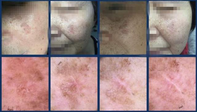 日光性角化病有多少患者