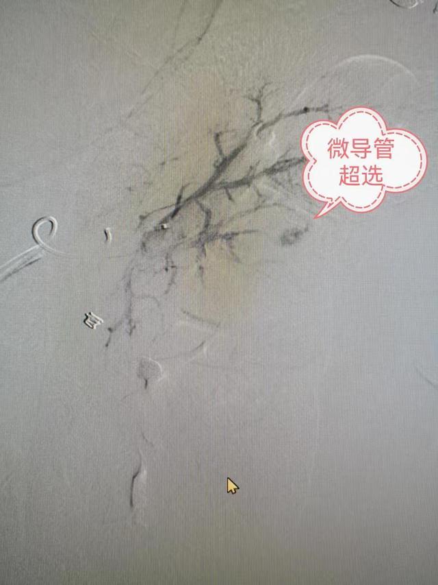 50岁男子每天跑20公里诱发肾破裂