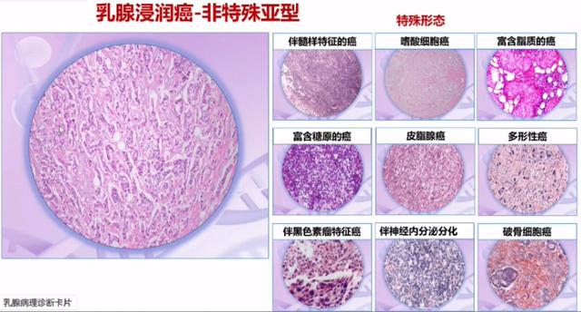 7大更新要點！專家解讀2022 CSCO乳腺癌指南病理診斷部分