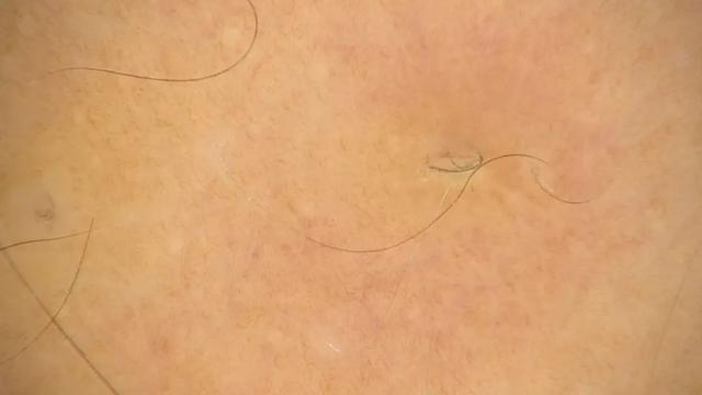 激光去除鸡皮肤有效吗