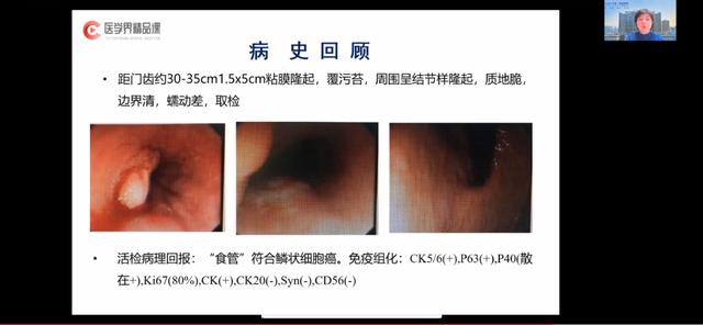 食管癌免疫治疗病例分析:疗效如何?方案怎么选?
