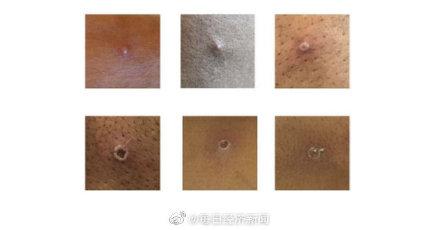 英国再发现两例猴痘确诊病例 症状类似于天花