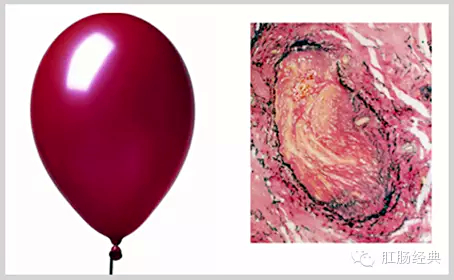 百变痔疮，图说本质