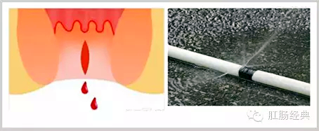 百变痔疮，图说本质