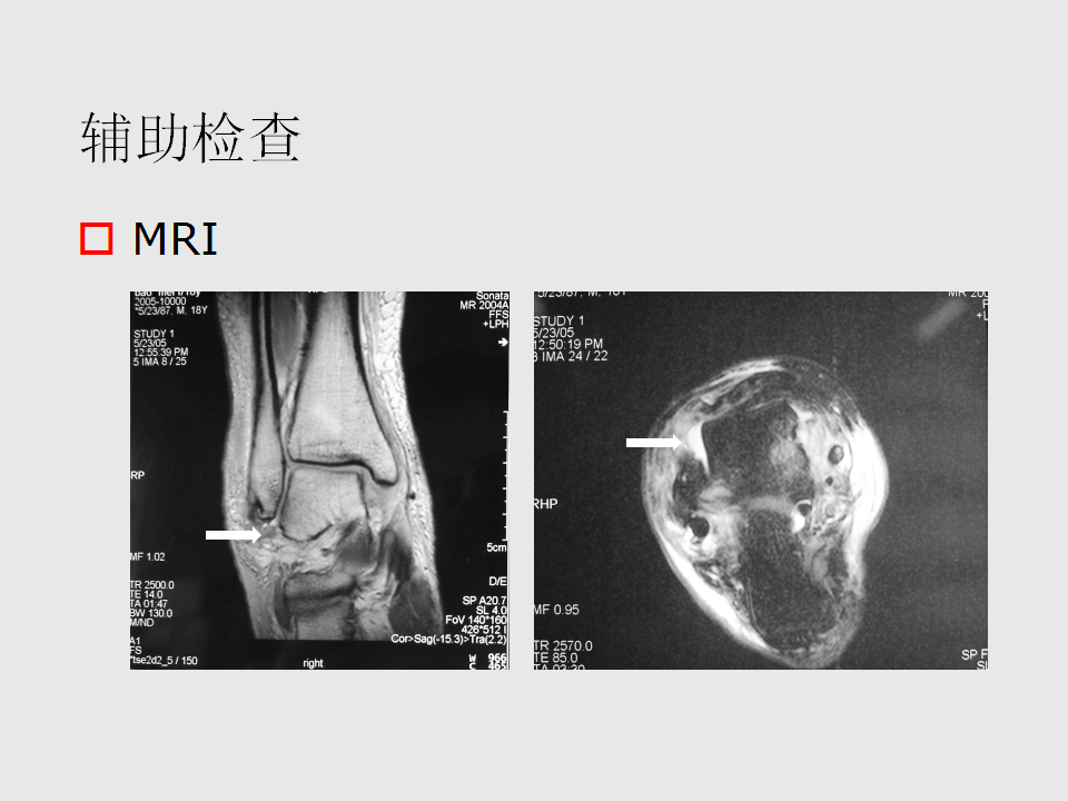 脚崴了怎么办？