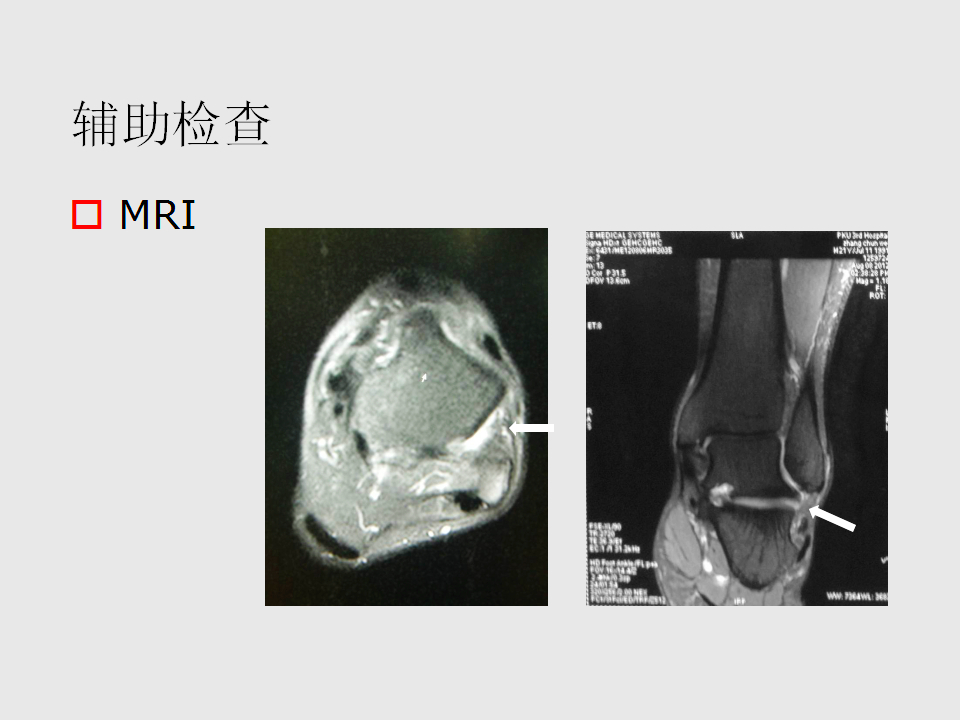 脚崴了怎么办？