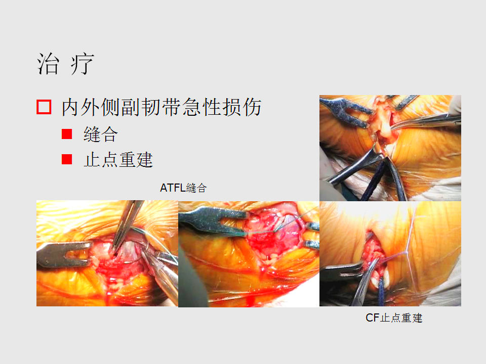 脚崴了怎么办？