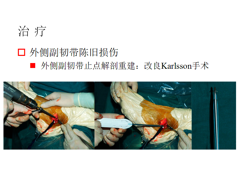 脚崴了怎么办？