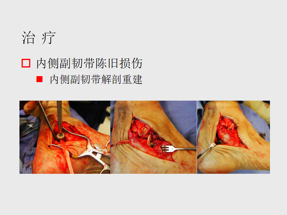 脚崴了怎么办？