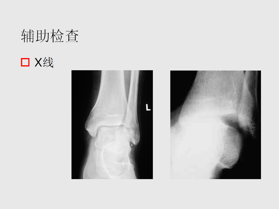 脚崴了怎么办？