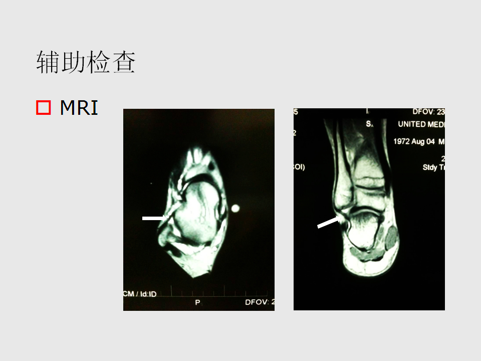 脚崴了怎么办？