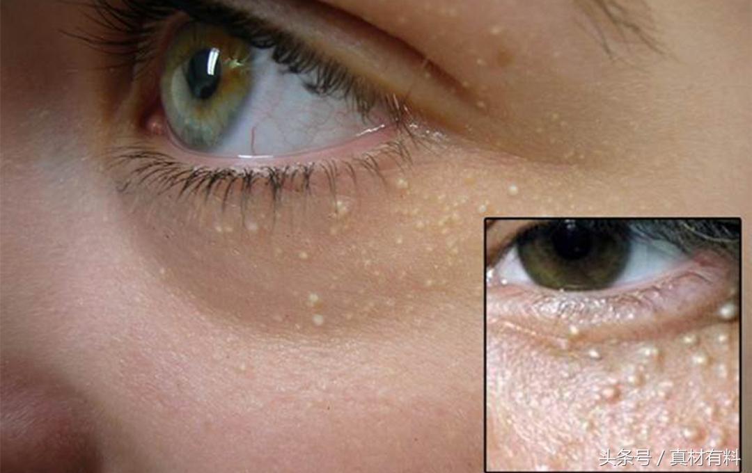 脂肪粒外观成米色颗粒状,顾名思义,看着像一个小点点的肉包,治疗相对