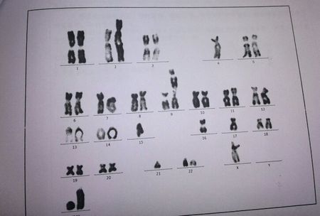 35岁以上的高龄孕妇要做染色体检查