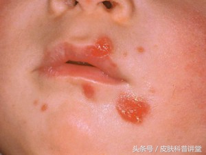 脓疱疮的症状就是细菌感染导致的急性化脓性皮肤病