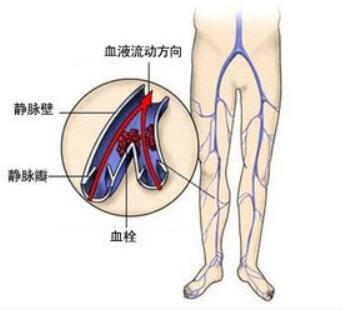 静脉炎非手术治疗方法及最佳治疗方案