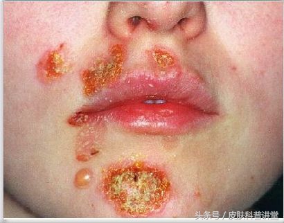 脓疱疮说白了就是细菌感染,最常见的致病菌就是金黄色葡萄球菌和溶血