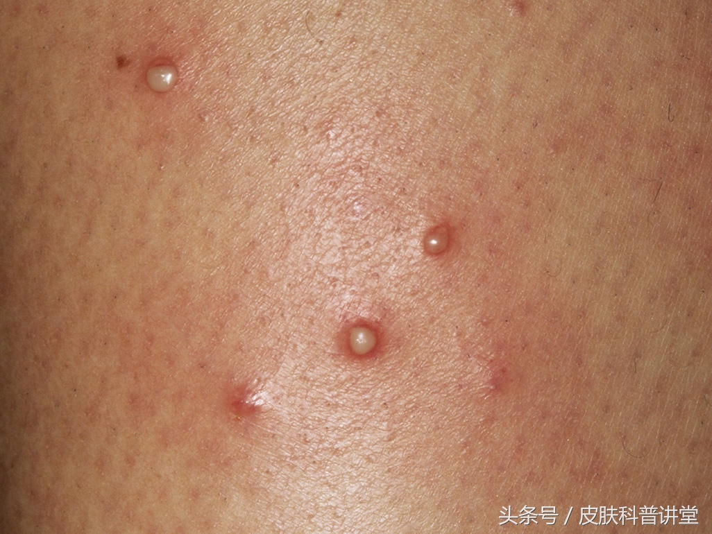 皮肤科普讲堂一日一病例,010 毛囊炎