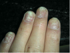 女幼师滑雪断指赖美甲？不当美甲存在这些隐患