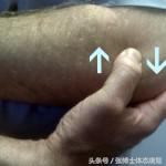 网球肘疼痛如何有效缓解？体态康复专家教你科学治疗与预防方法
