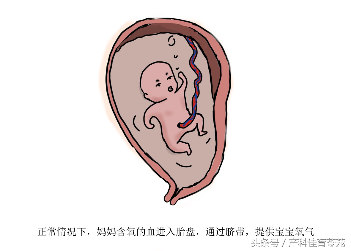 危及妈妈和宝宝生命的胎盘早剥