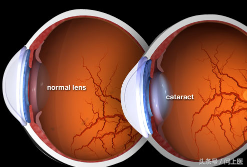 白內障的早期症狀圖片(圖解白內障) - 赤虎壹號
