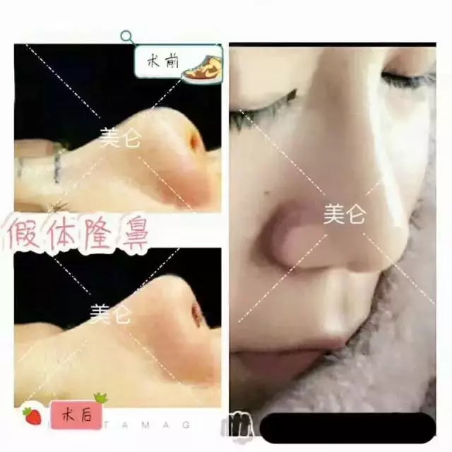 什么是鼻综合整形？包括哪些项目？