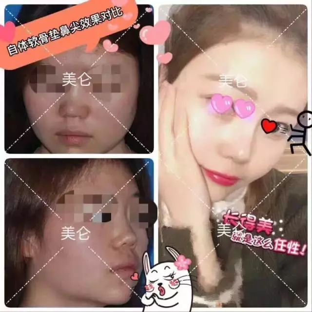 什么是鼻综合整形？包括哪些项目？