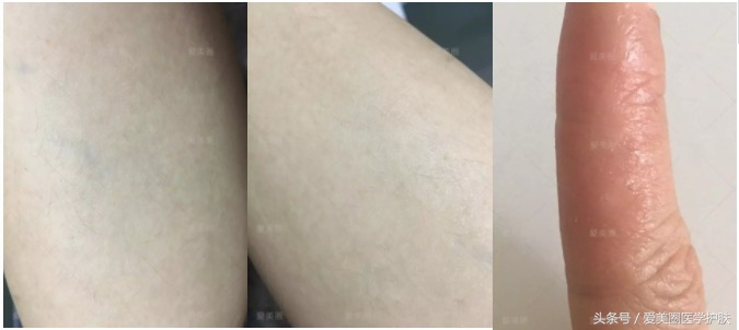 腿部肌肤干燥像鱼鳞，鱼鳞病护理方法get起来～