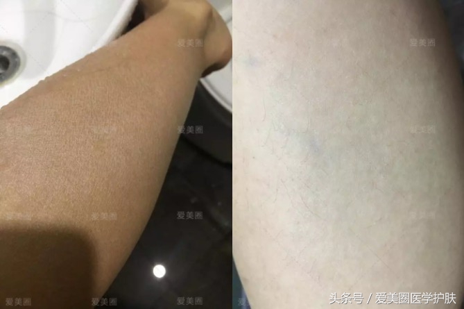 腿部肌肤干燥像鱼鳞，鱼鳞病护理方法get起来～