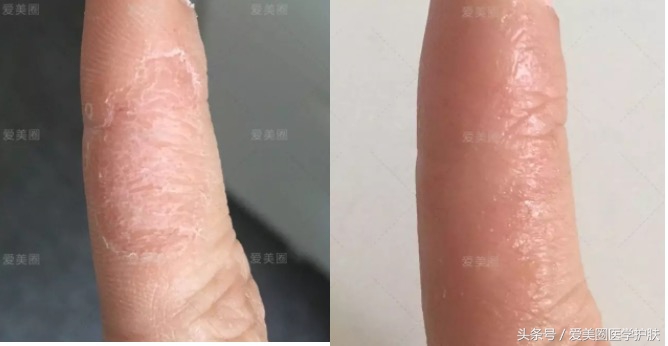腿部肌肤干燥像鱼鳞，鱼鳞病护理方法get起来～