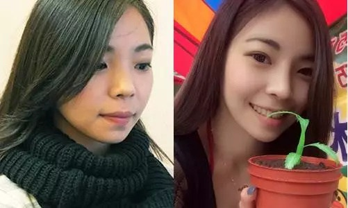 综合隆鼻术后三个月恢复效果，变身小仙女，鼻型为：塌鼻+短鼻