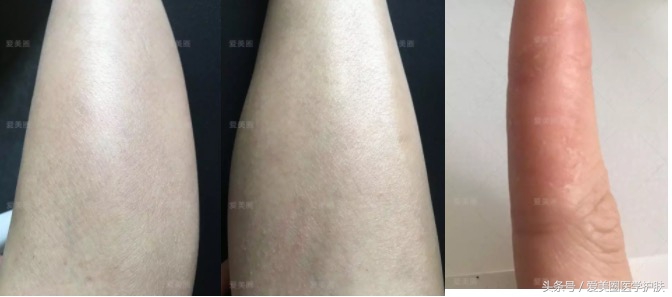 腿部肌肤干燥像鱼鳞，鱼鳞病护理方法get起来～