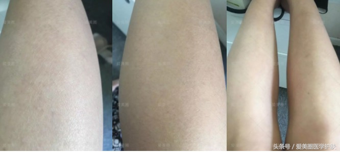 腿部肌肤干燥像鱼鳞，鱼鳞病护理方法get起来～