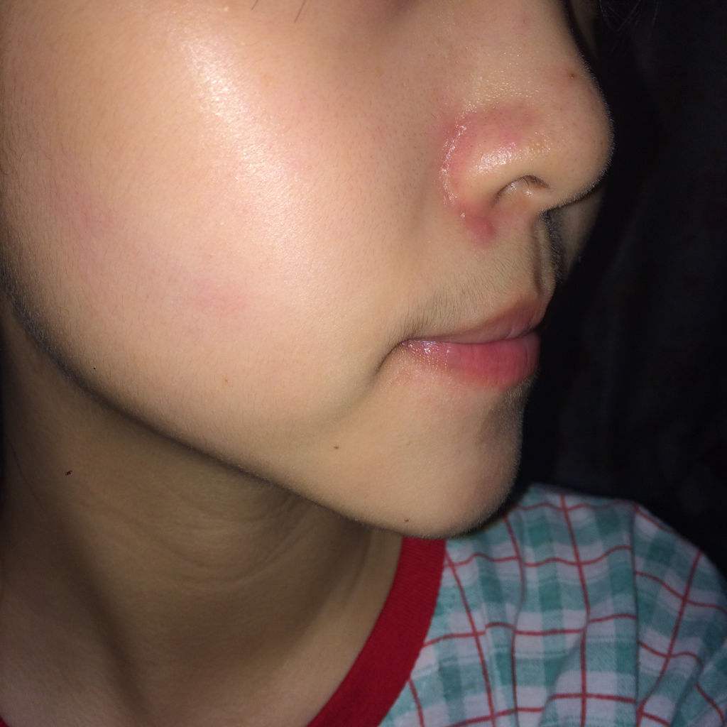 鼻翼两边红血丝太严重,美颜把鼻子都磨没了才看不到!该怎么办?