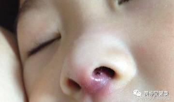 火疖子是什么