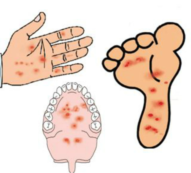 手足口图片症状图片_手足口病初期症状图片_手足口初期症状图片