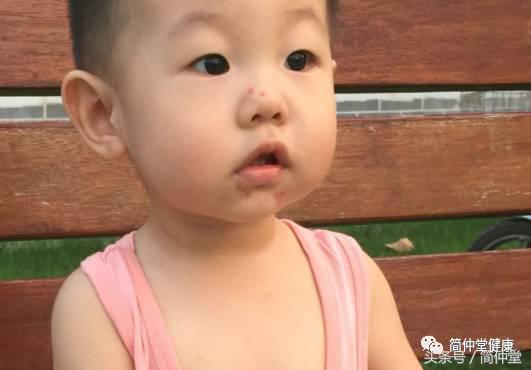 火疖子是什么