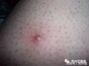 火疖子是什么？长疖子的原因和处理方法