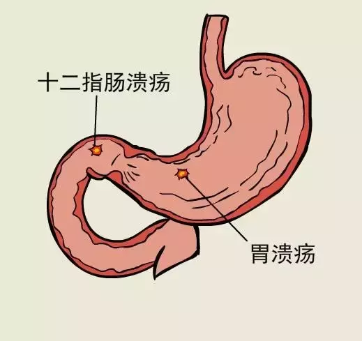 婴儿大便潜血阳性意味着什么（孩子出现恶心）