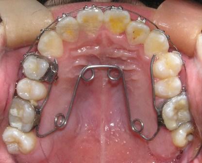 (口腔科普第22期)