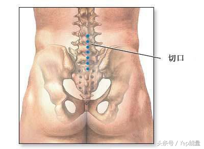 腰椎间盘突出症手术费要多少？来自医生们的回答