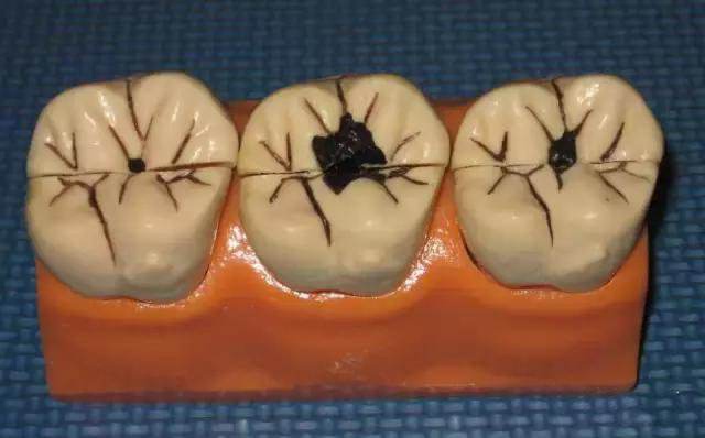 牙齿髓底穿的高清图片(如何判断自己需要补牙) - 赤虎壹号