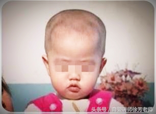 对照下，九大婴幼儿缺钙症状你家娃有哪几条？附鉴别