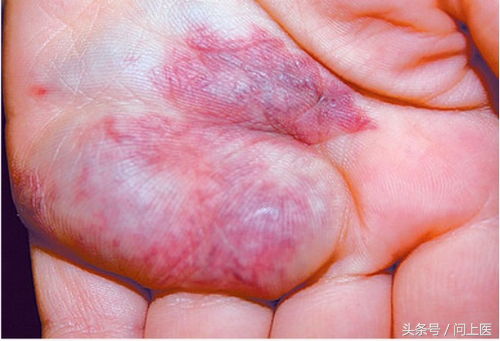 "天使的吻"——图解8种常见胎记