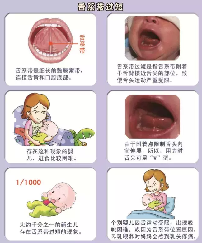 正常婴儿舌系带图片图片