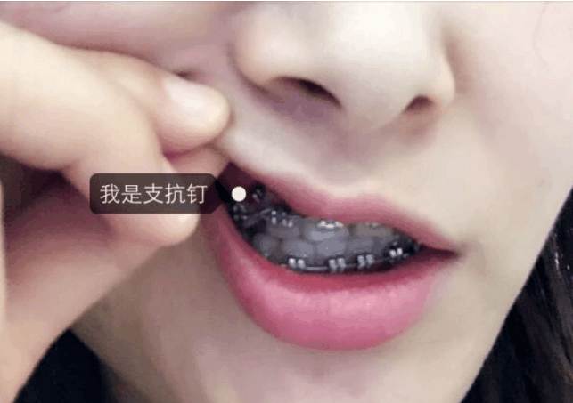 牙钉多少钱一颗牙齿矫正打支抗钉疼吗
